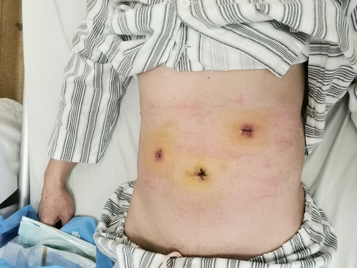 溪尾大叔腹部劇痛竟是腸穿孔，幸好外三科及時施治！